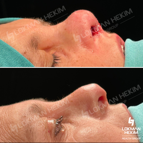 Rinoplastia (con injerto) Foto antes/después